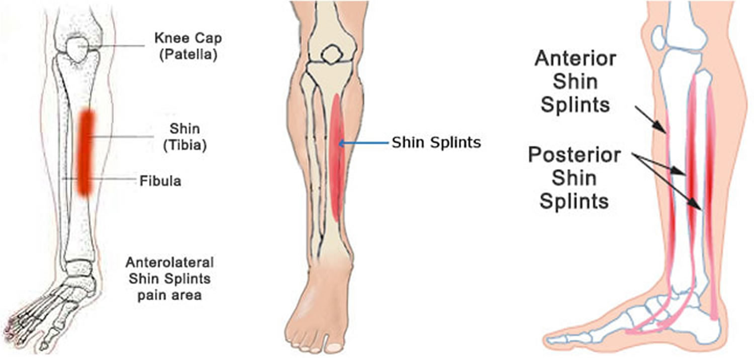 Shin Splints - Causes, Symptoms, How To Get Rid Of Shin Splints