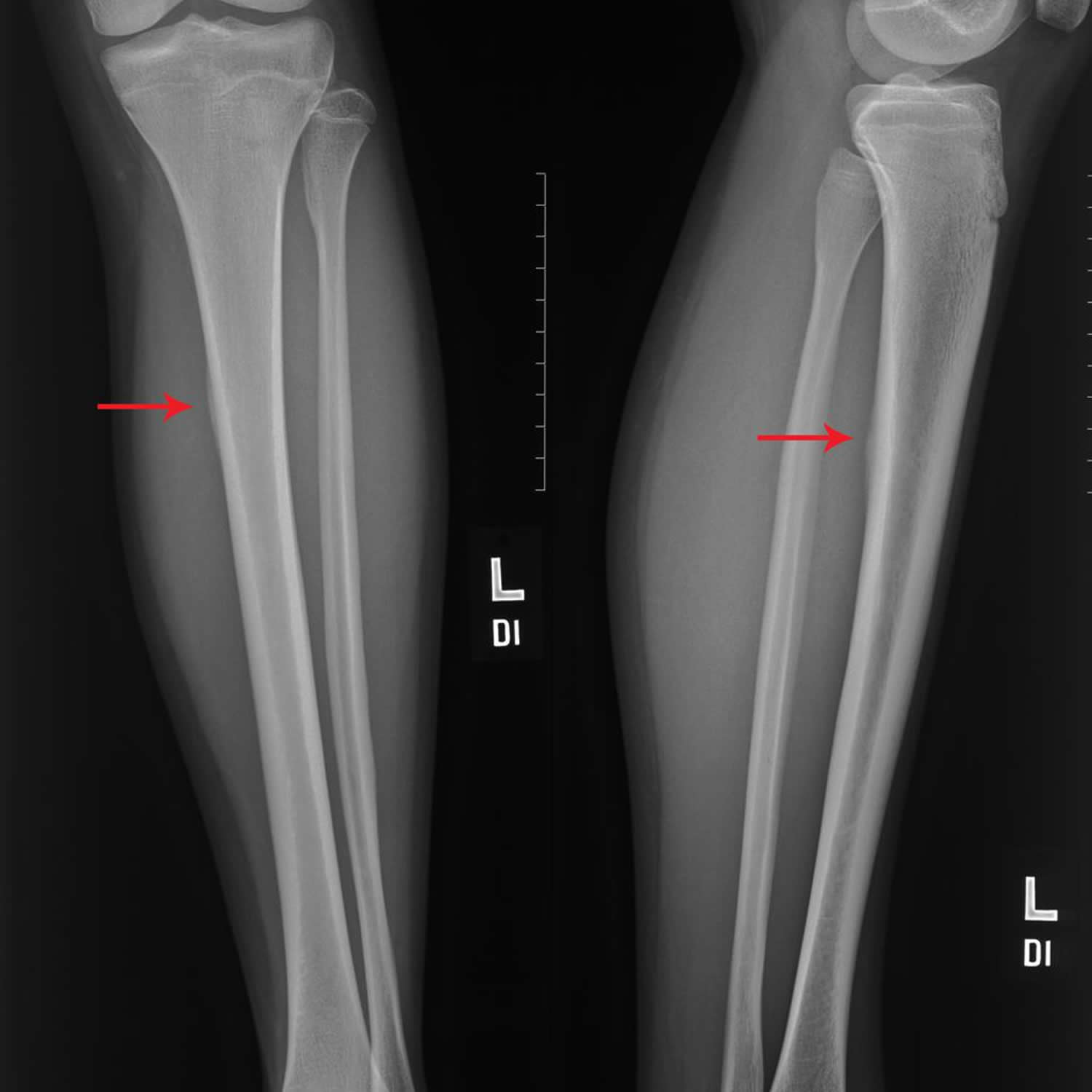 x ray stress fracture shin