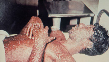 smallpox rash