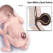 spina bifida