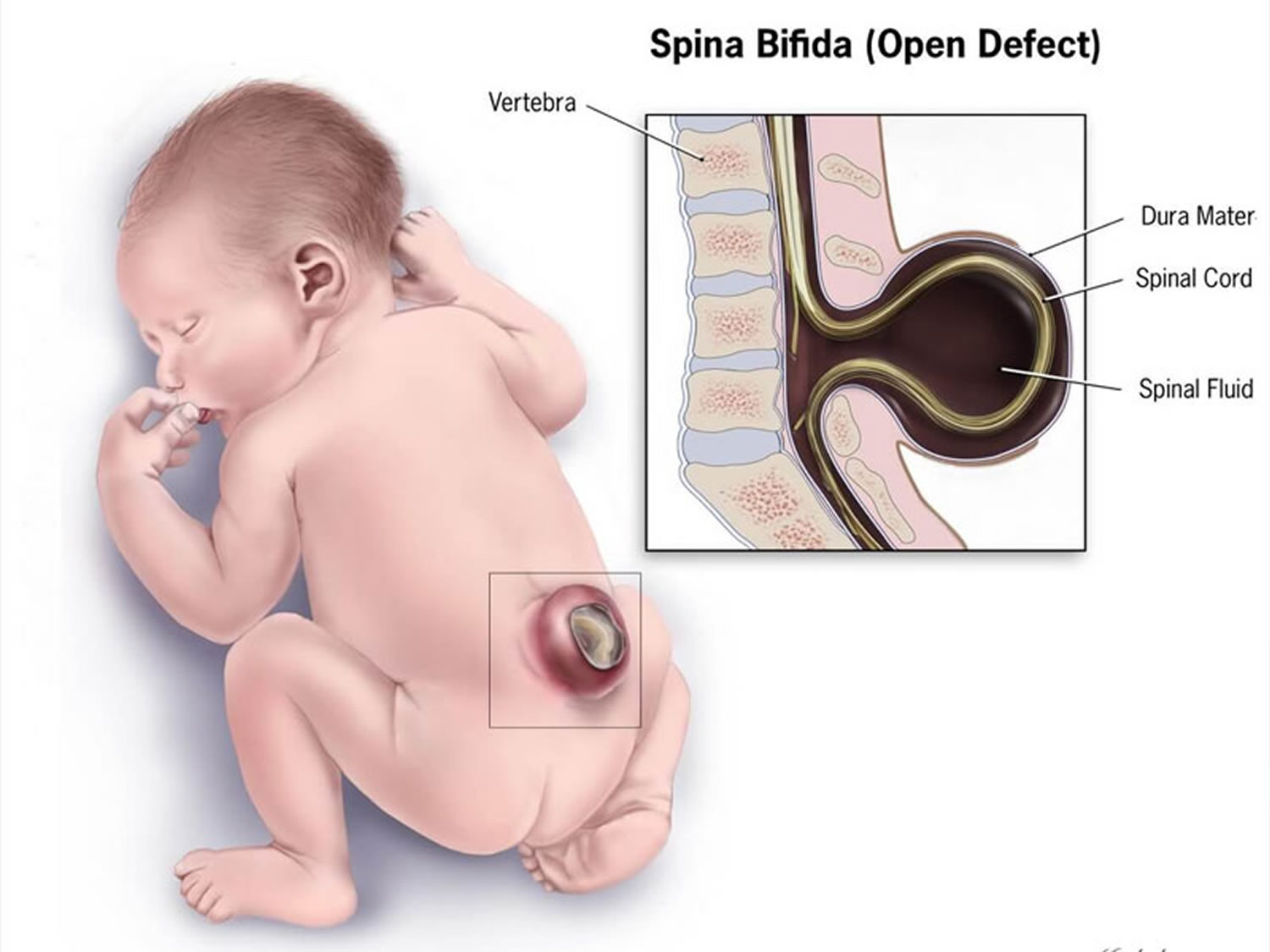 spina bifida occulta life expectancy