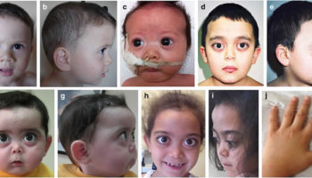 stickler syndrome