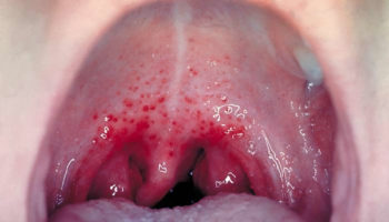 strep throat