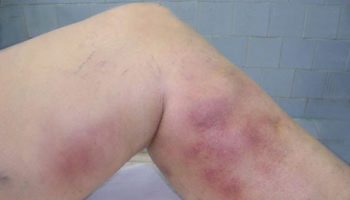 superficial thrombophlebitis