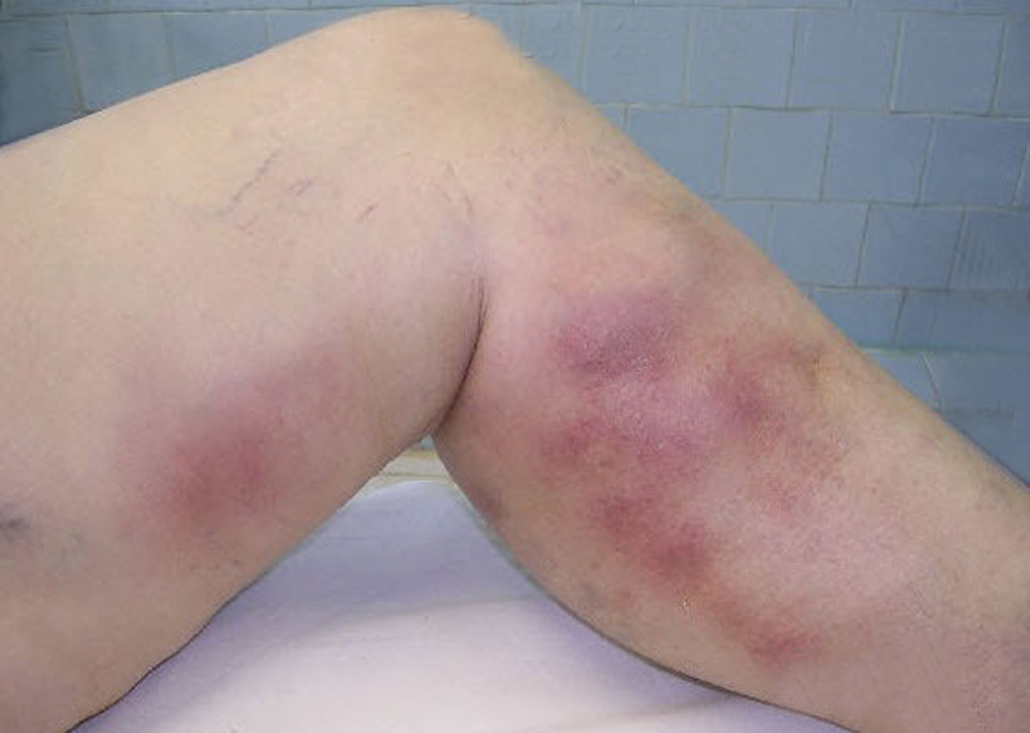 Superficial thrombophlebitis