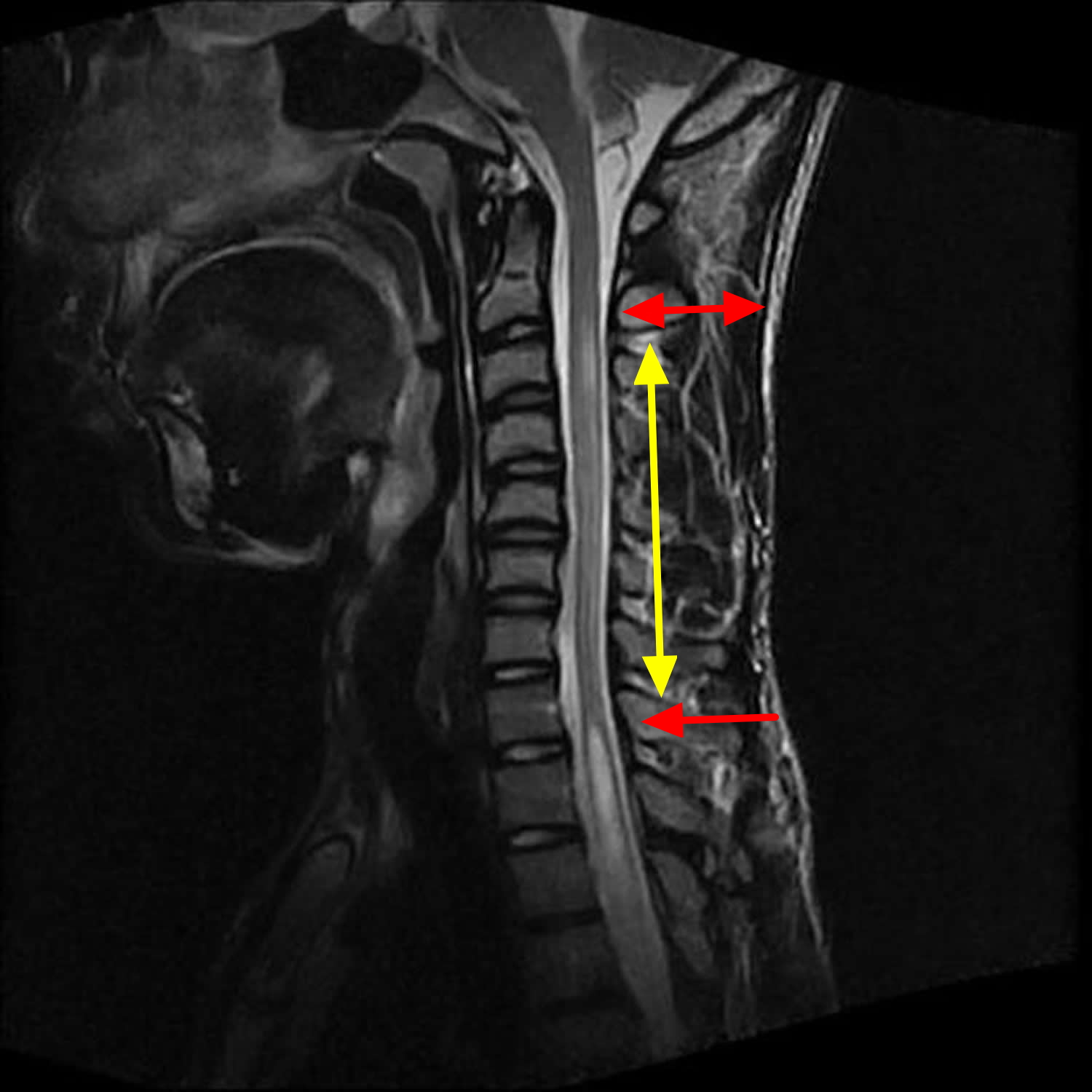 Syringomyelia - Causes, Symptoms, Prognosis, Treatment