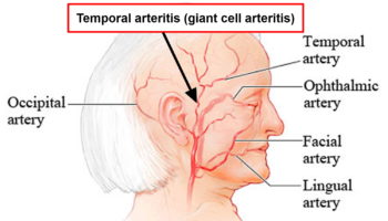 temporal arteritis