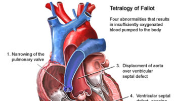 tetralogy of fallot