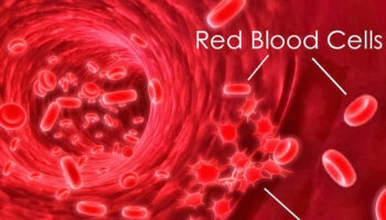 thrombocytopenia