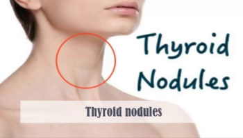 thyroid nodules