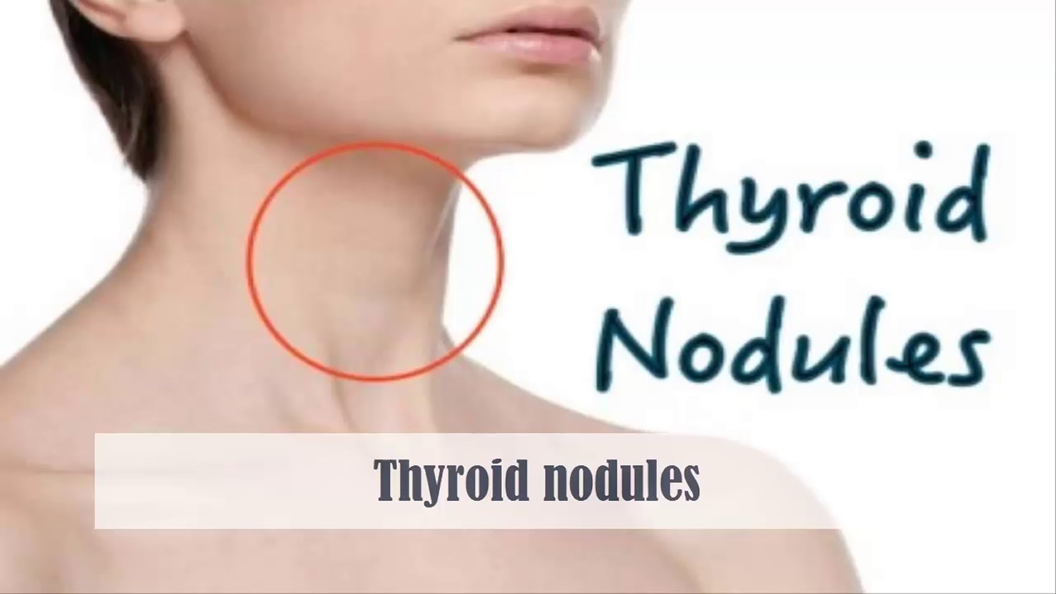 Thyroid Nodules - Causes, Symptoms, Ultrasound, Surgery