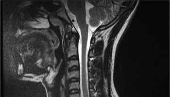 transverse myelitis