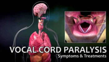 vocal cord paralysis