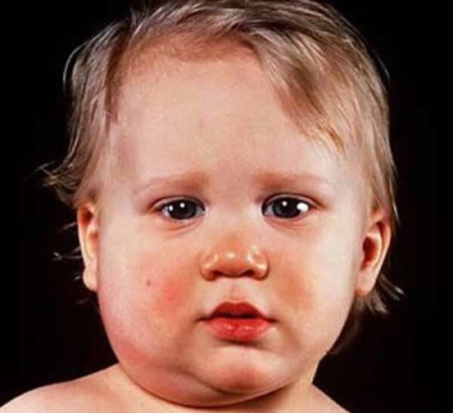 mumps-symptoms-what-mumps-look-like-vaccine-treatment