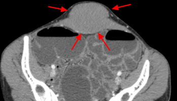 Abdominal desmoid tumor