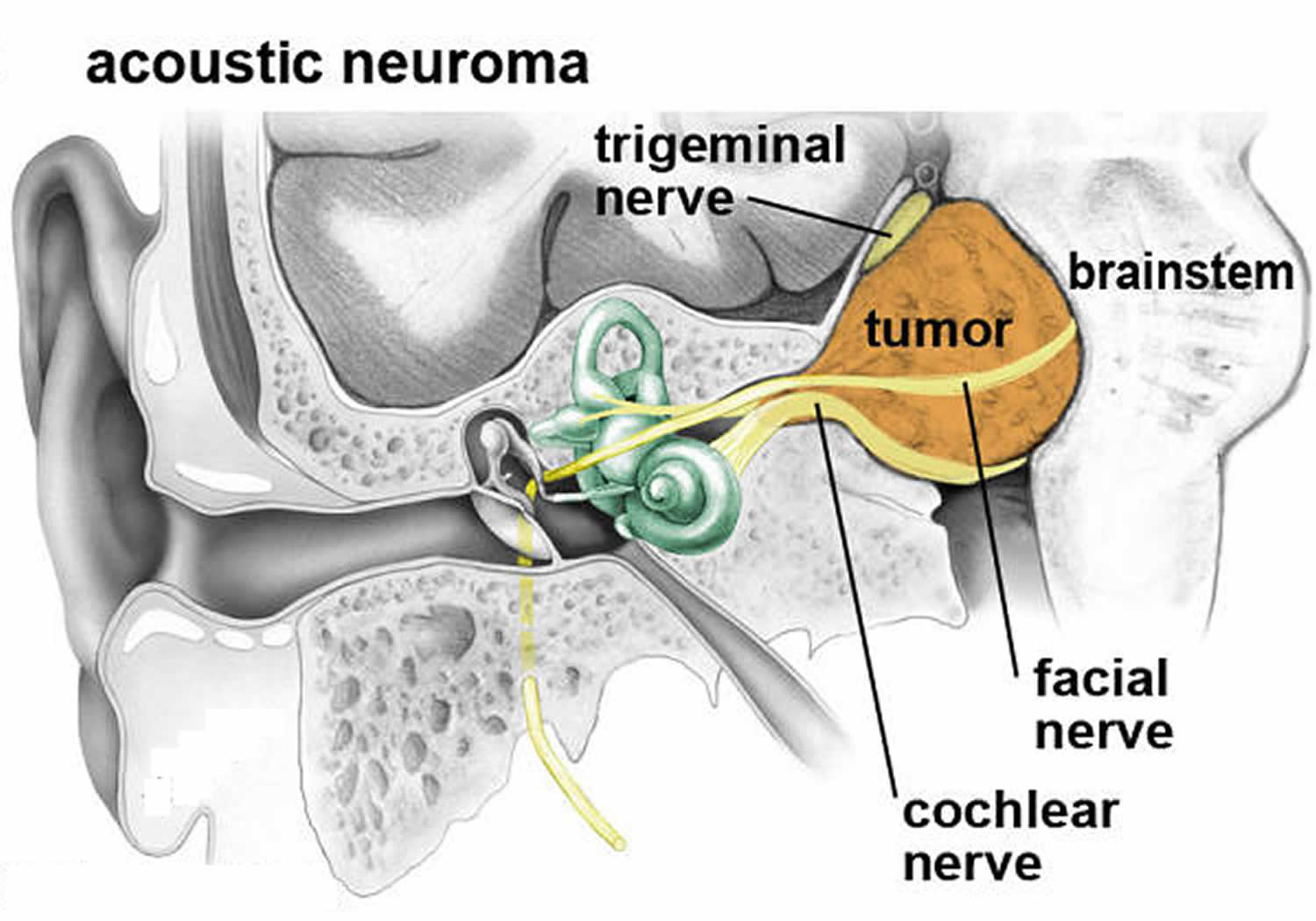 Tumor schwannoma Vagal Nerve