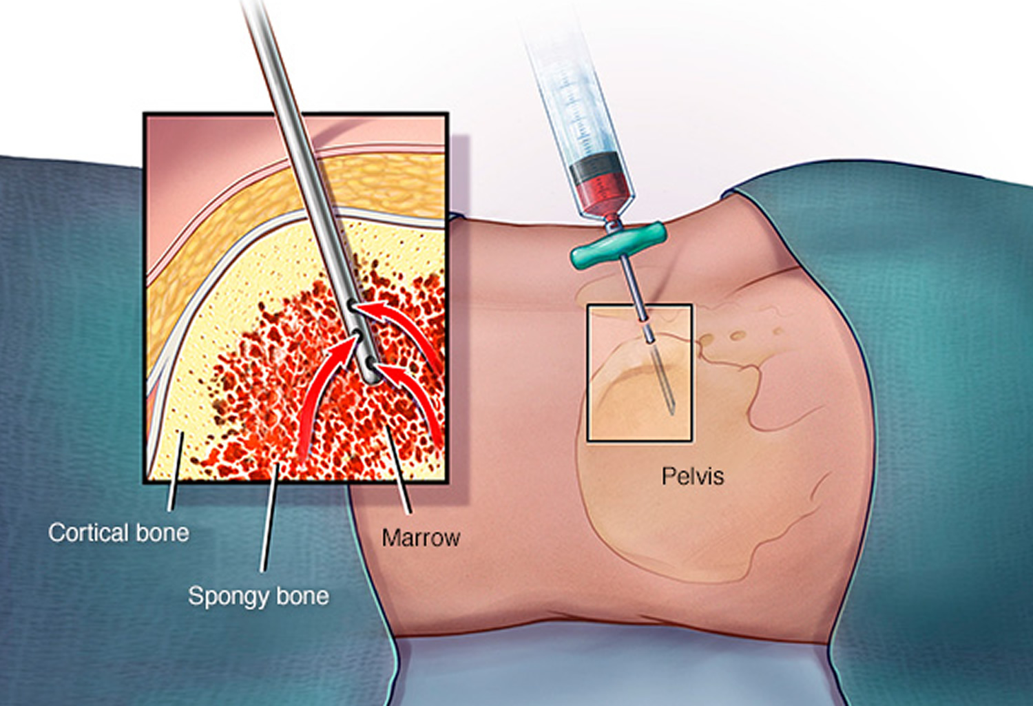 myelofibrosis-causes-symptoms-prognosis-diagnosis-treatment