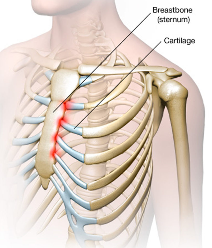 Costochondritis Causes, Symptoms, Locations, Duration & Treatment