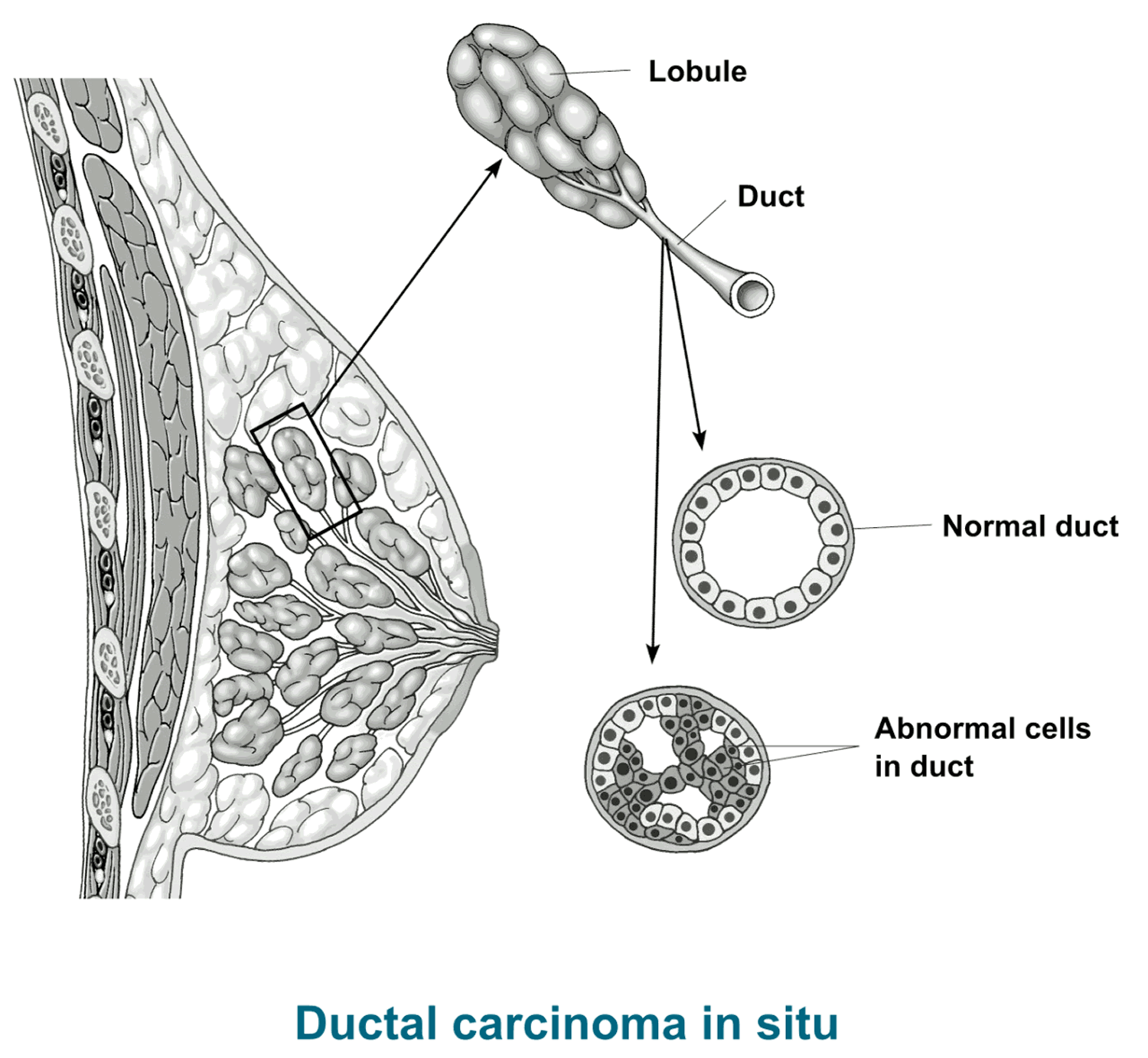 dcis-causes-symptoms-diagnosis-survival-rate-treatment