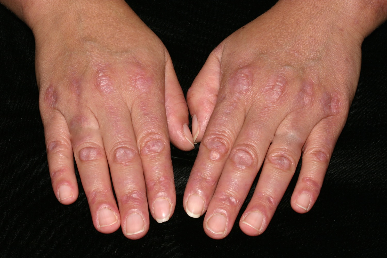 Polymyositis - Causes, Symptoms, Prognosis, Diagnosis, Treatment