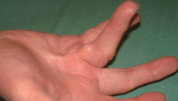 Dupuytren’s contracture