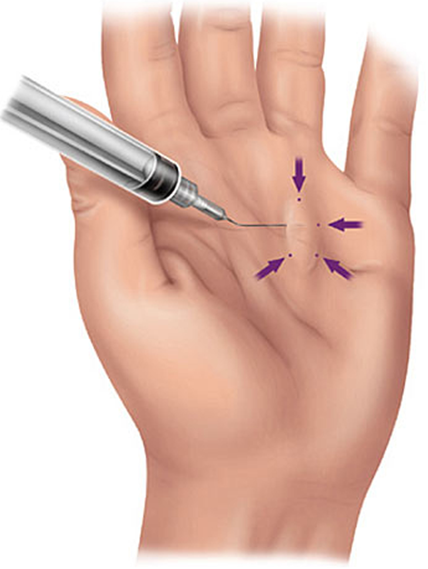 dupuytren-s-contracture-causes-symptoms-treatment