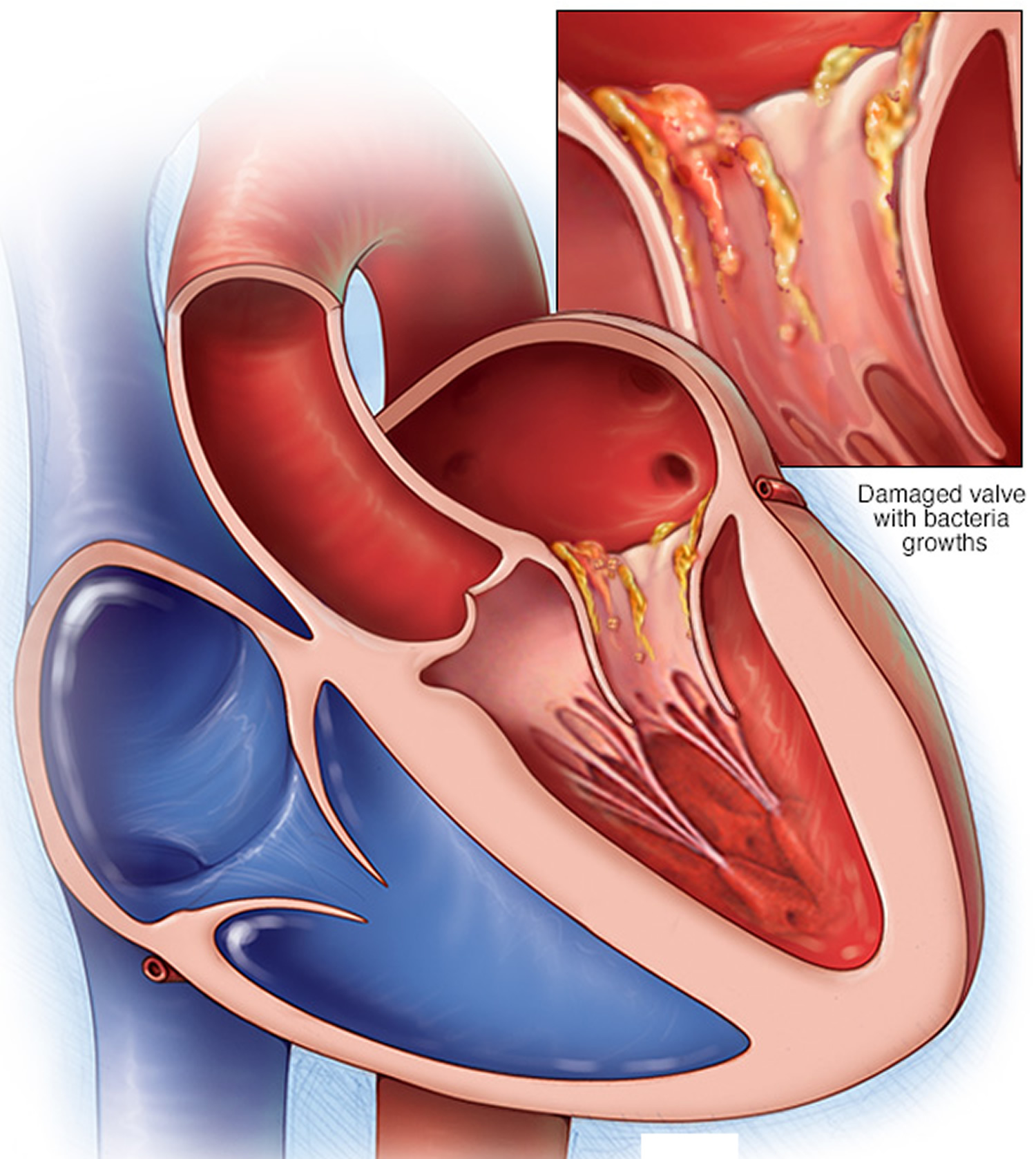 infective-endocarditis-causes-signs-symptoms-diagnosis-treatment