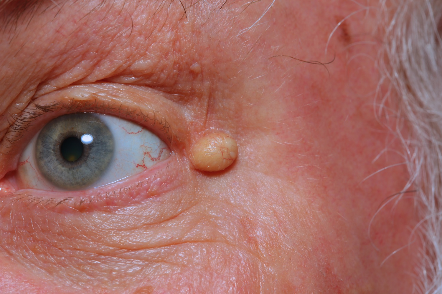 epidermoid-cyst-infected-causes-symptoms-treatment