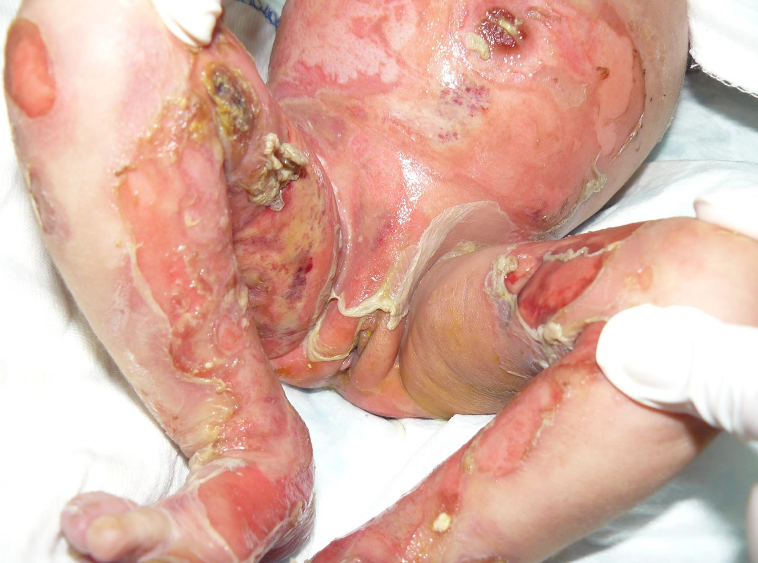 epidermolysis bullosa dystrophica