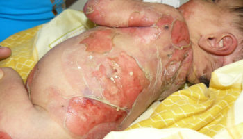 Epidermolysis bullosa