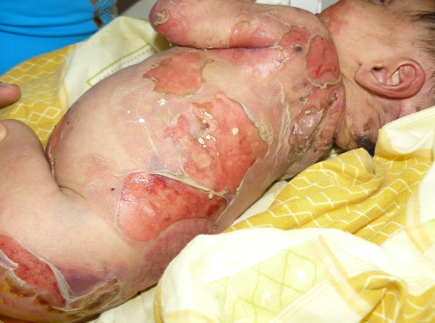 epidermolysis bullosa dystrophica