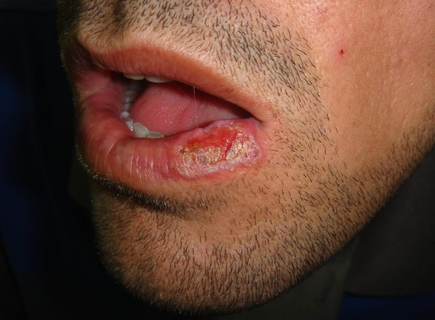 Erosive oral lichen planus