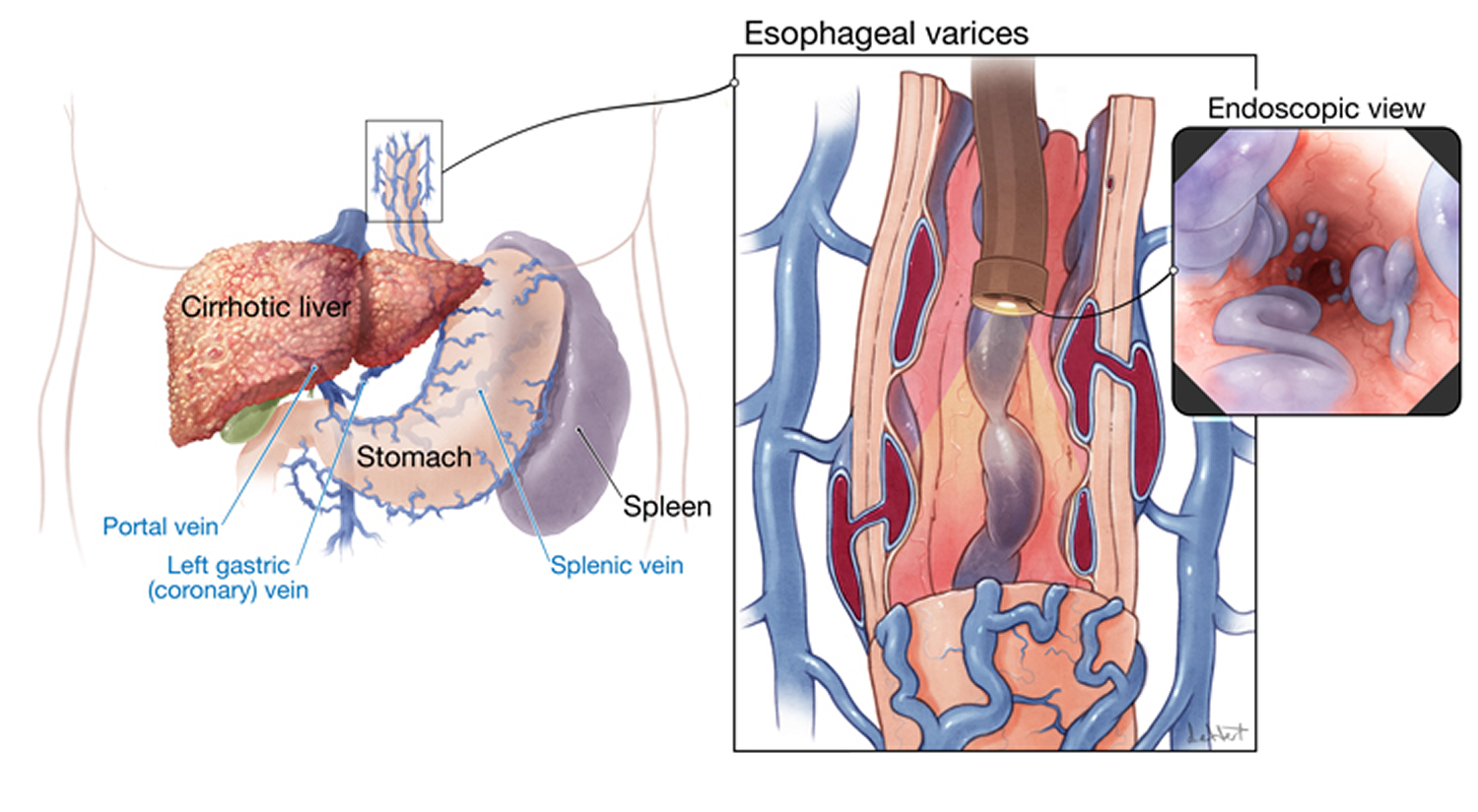 Esophageal varices