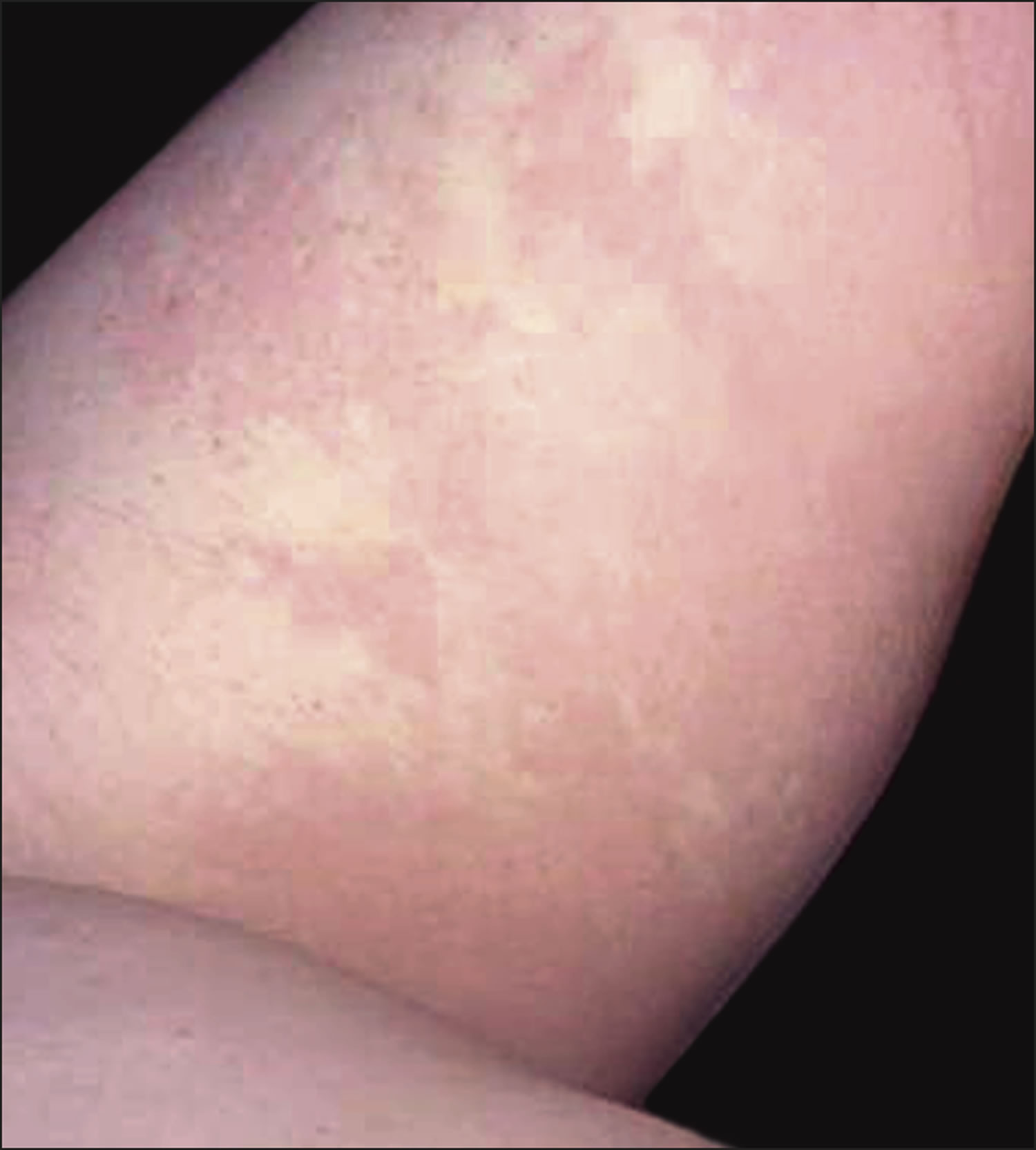 Familial Mediterranean Fever Causes Symptoms Rash Treatment