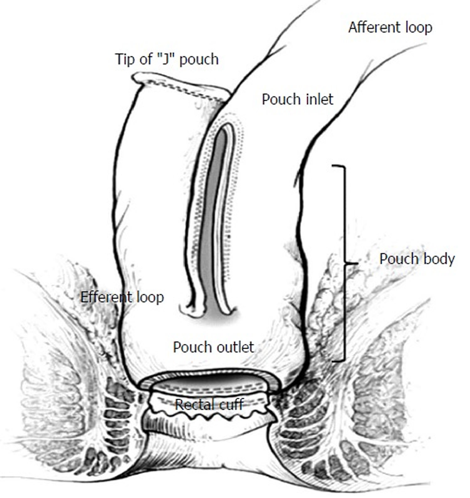 J-pouch anatomy