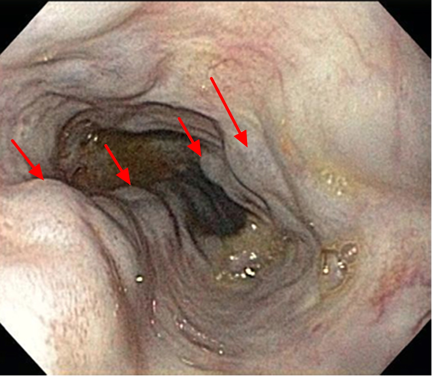 Large Esophageal Varices