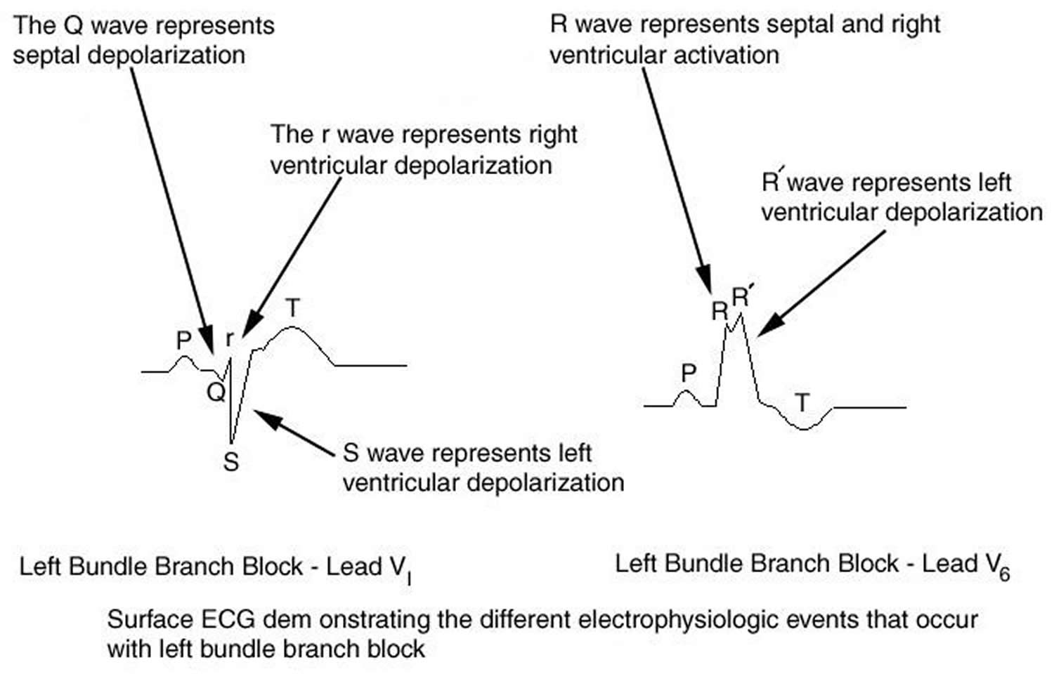 Left bundle branch block ECG pattern