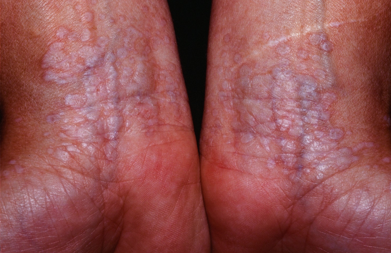 lichen sclerosus