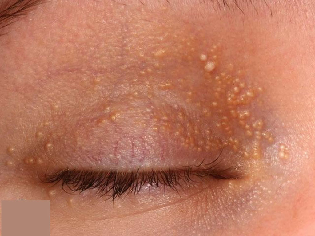 Milia - Causes, Milia On Face, Eyelid & How To Get Rid of It