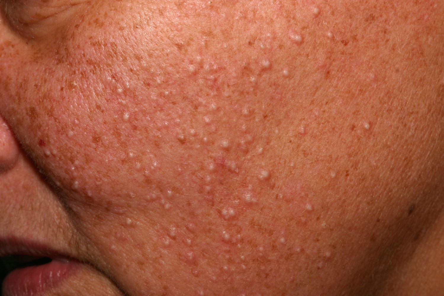 Clear Bumps On Face Not Milia