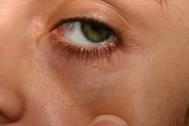 how-to-get-rid-of-milia-those-white-spots-under-your-eyes-home