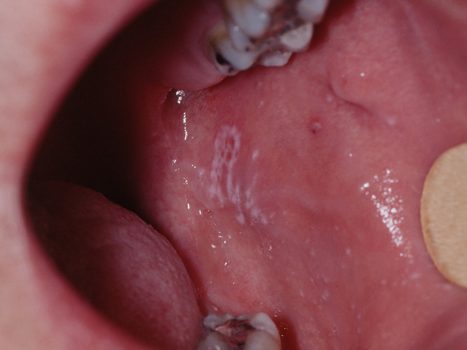 oral lichen planus cheek