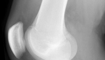 Osgood-Schlatter disease