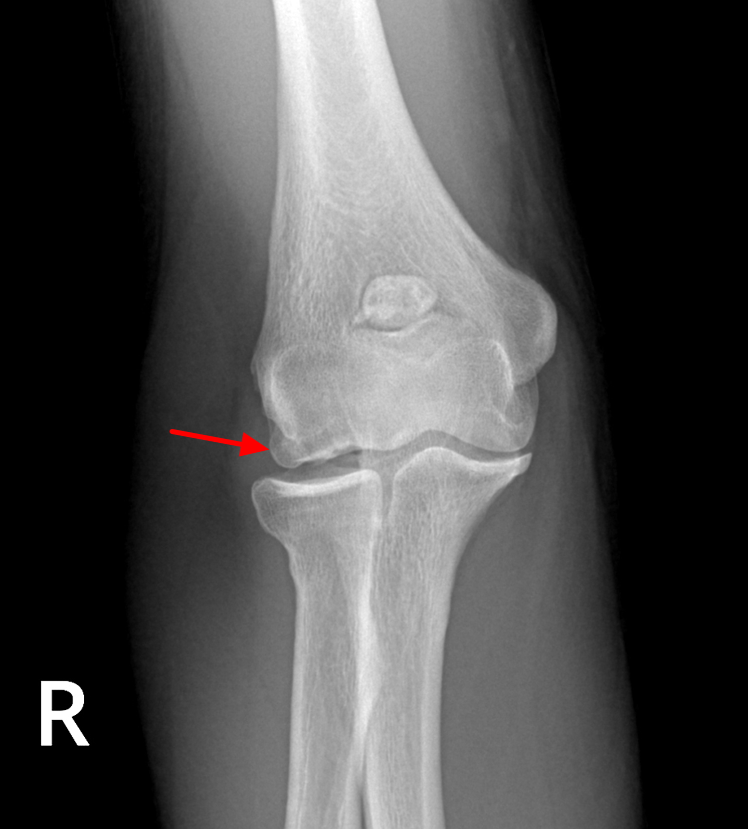 osteochondrite coude - ostéochondrite du genou chez l'adulte