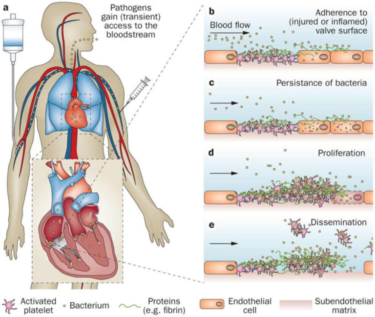 Infective Endocarditis - Causes, Signs, Symptoms, Diagnosis & Treatment