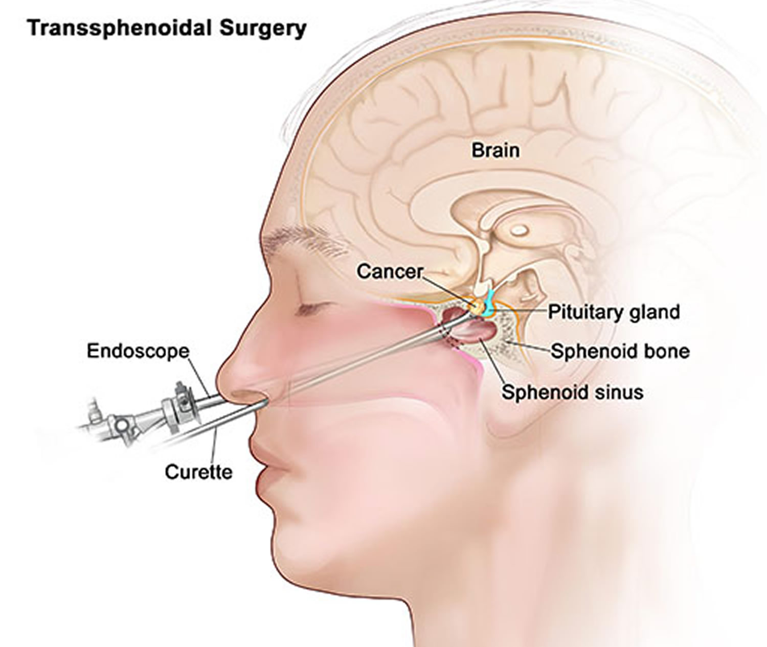 Pituitary Tumor - Signs, Symptoms, Diagnosis, MRI, Surgery & Treatment
