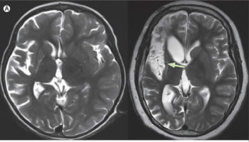 Rasmussen encephalitis