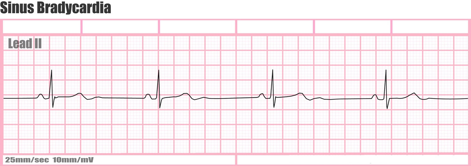 bradycardia sinus ecg beats minute per figure