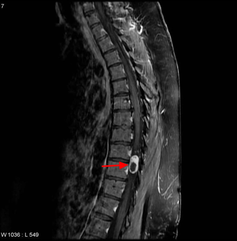 Schwannoma - Causes, Symptoms, Diagnosis. Treatment