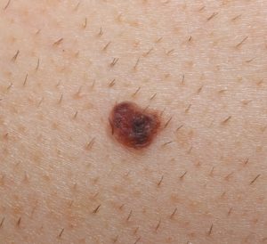 Moles - Causes, Types, Abnormal, Cancerous Moles